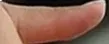 Thumb severity 1